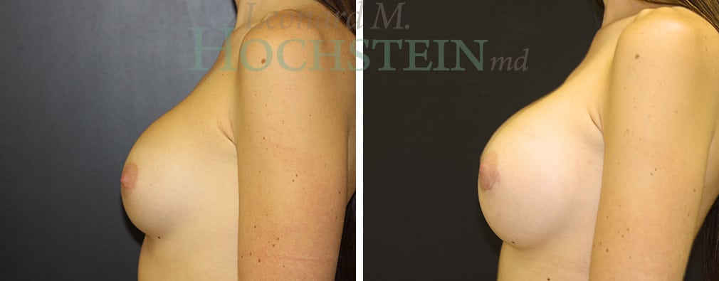 Breast Augmentation Patient