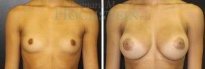 Breast Augmentation Patient