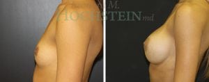 Breast Augmentation Patient