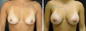 Breast Augmentation Patient