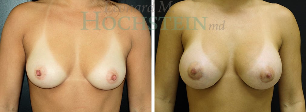 Breast Augmentation Patient