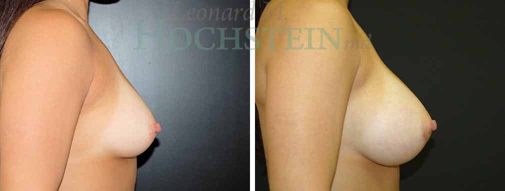 Breast Augmentation Patient