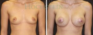 Breast Augmentation Patient