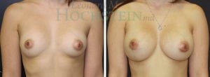 Breast Augmentation Patient