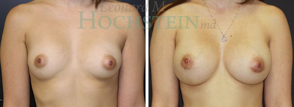 Breast Augmentation Patient