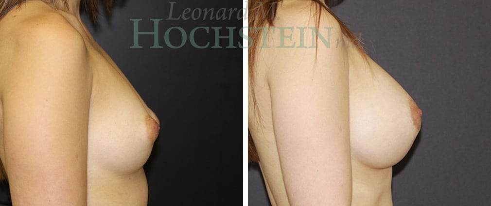 Breast Augmentation Patient