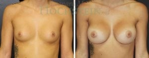 Breast Augmentation Patient