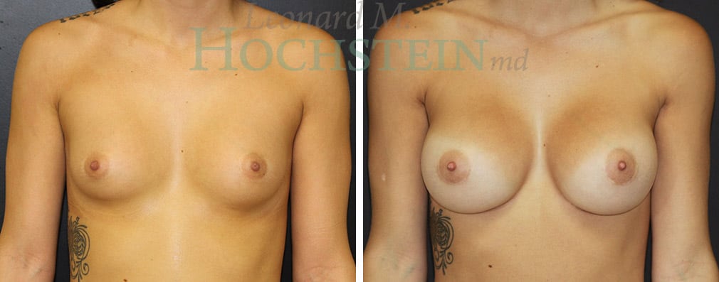 Breast Augmentation Patient