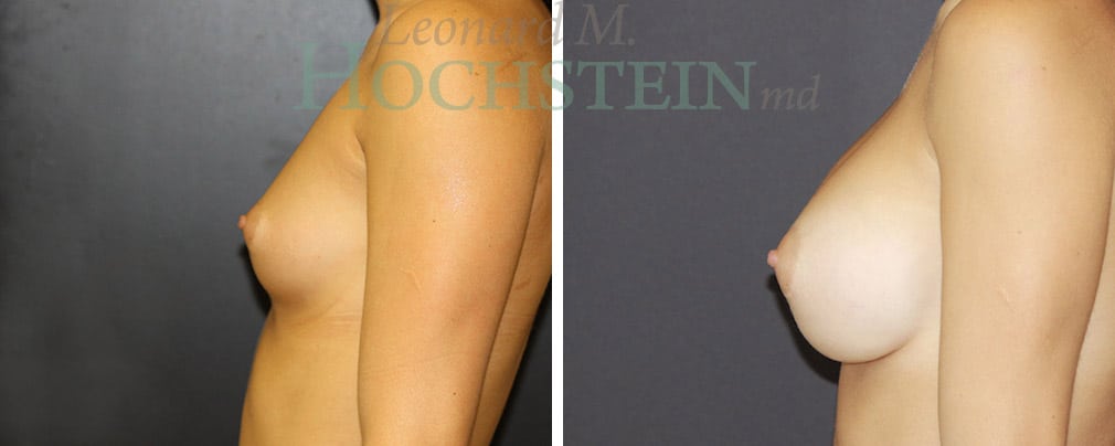 Breast Augmentation Patient