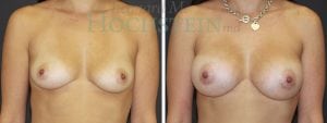 Breast Augmentation Patient