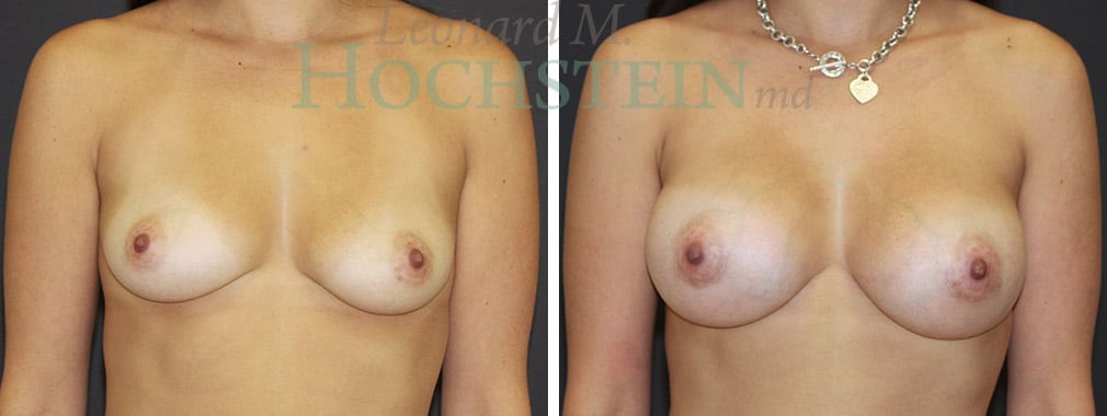 Breast Augmentation Patient