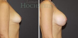 Breast Augmentation Patient