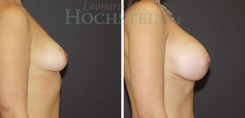 Breast Augmentation Patient