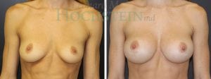 Breast Augmentation Patient