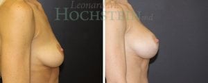 Breast Augmentation Patient
