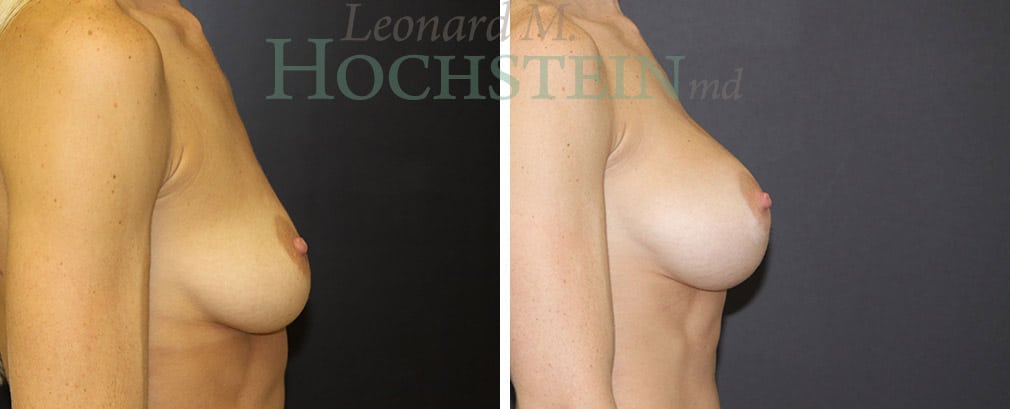 Breast Augmentation Patient