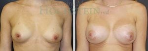 Breast Augmentation Patient