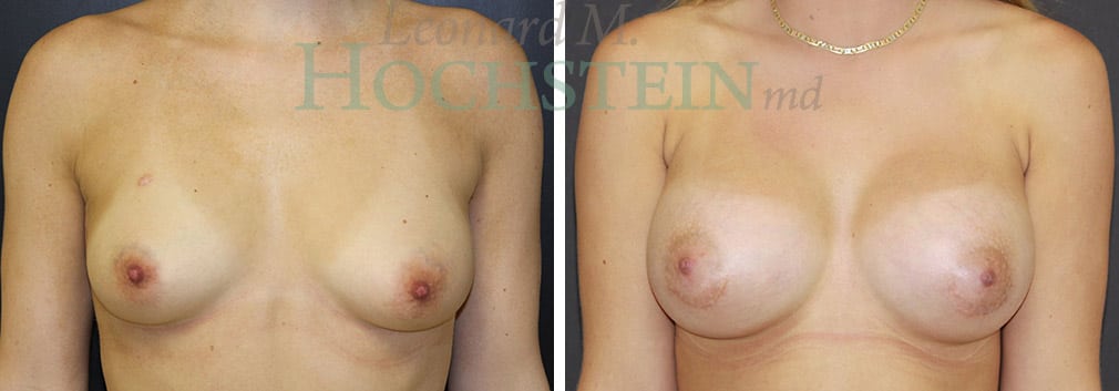 Breast Augmentation Patient