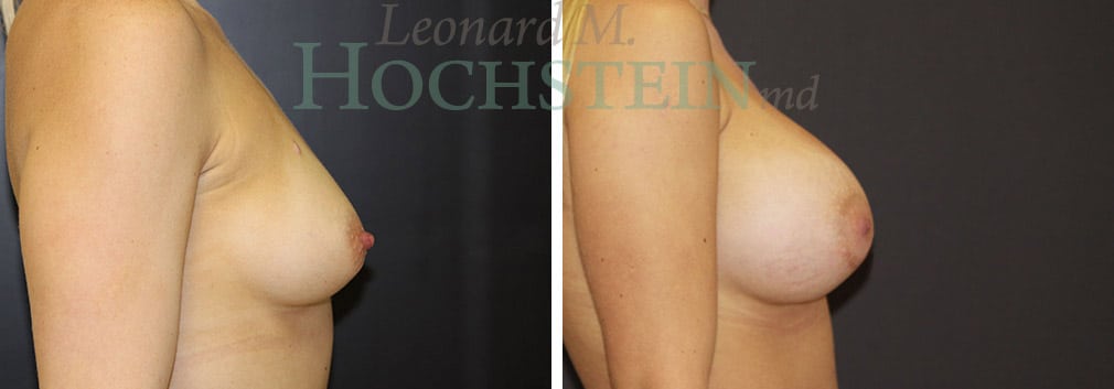Breast Augmentation Patient