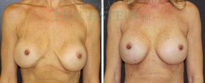 Breast Augmentation Patient