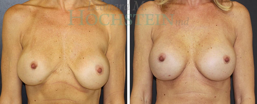 Breast Augmentation Patient