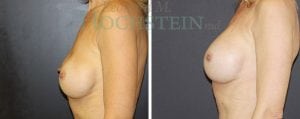Breast Augmentation Patient