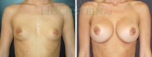 Breast Augmentation Patient
