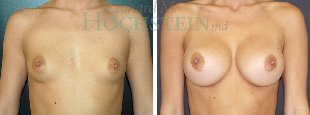 Breast Augmentation Patient