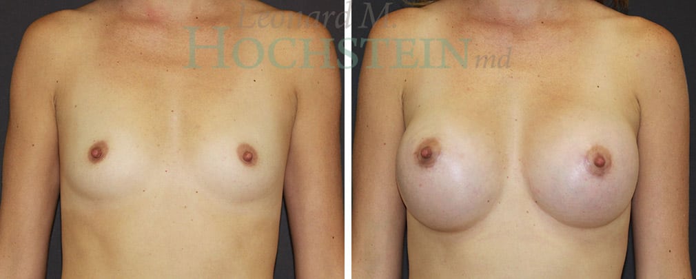 Breast Augmentation Patient
