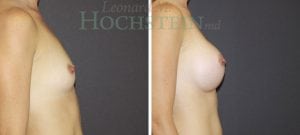 Breast Augmentation Patient