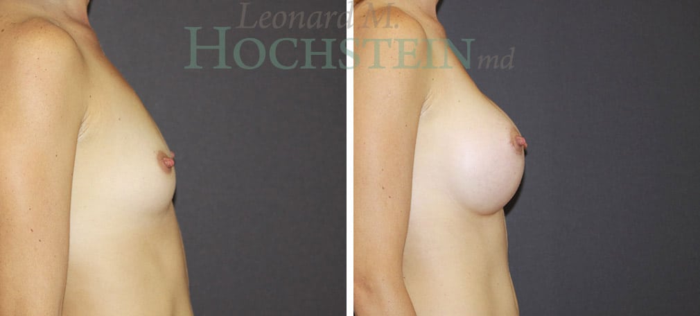 Breast Augmentation Patient