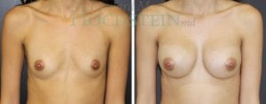 Breast Augmentation Patient