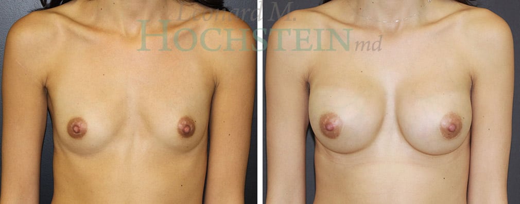 Breast Augmentation Patient