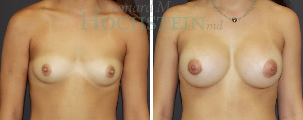Breast Augmentation Patient