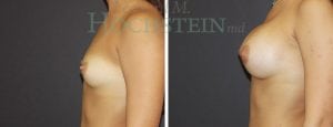 Breast Augmentation Patient