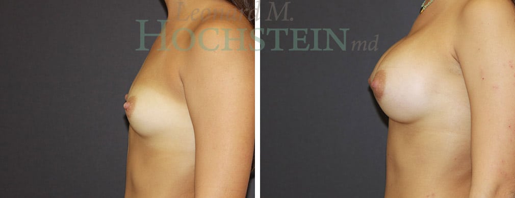 Breast Augmentation Patient