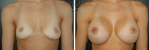 Breast Augmentation Patient