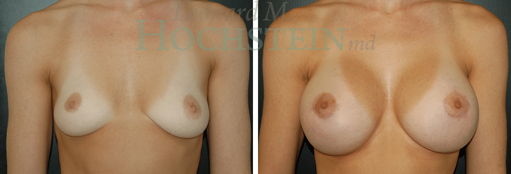 Breast Augmentation Patient