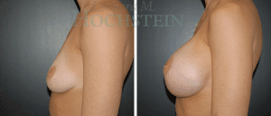 Breast Augmentation Patient
