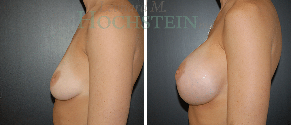 Breast Augmentation Patient