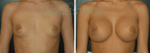 Breast Augmentation Patient