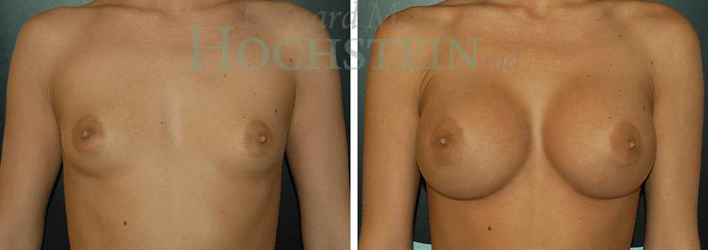 Breast Augmentation Patient