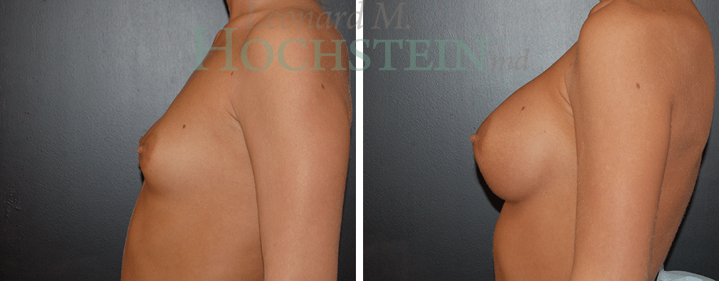 Breast Augmentation Patient