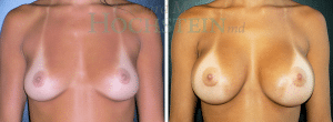Breast Augmentation Patient