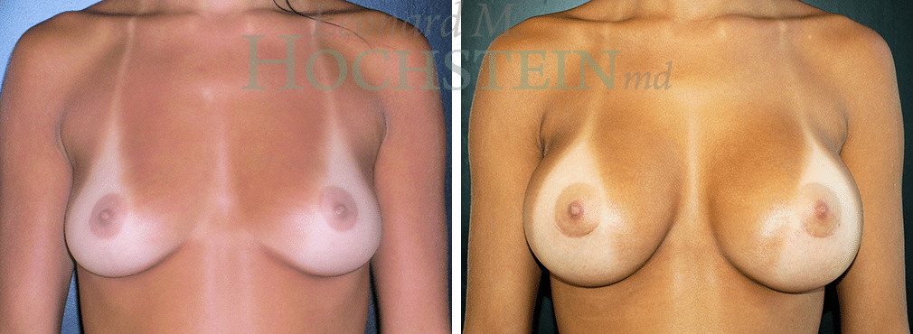 Breast Augmentation Patient