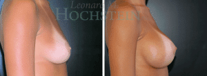 Breast Augmentation Patient