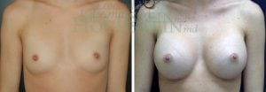Breast Augmentation Patient