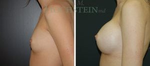 Breast Augmentation Patient