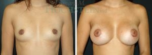 Breast Augmentation Patient
