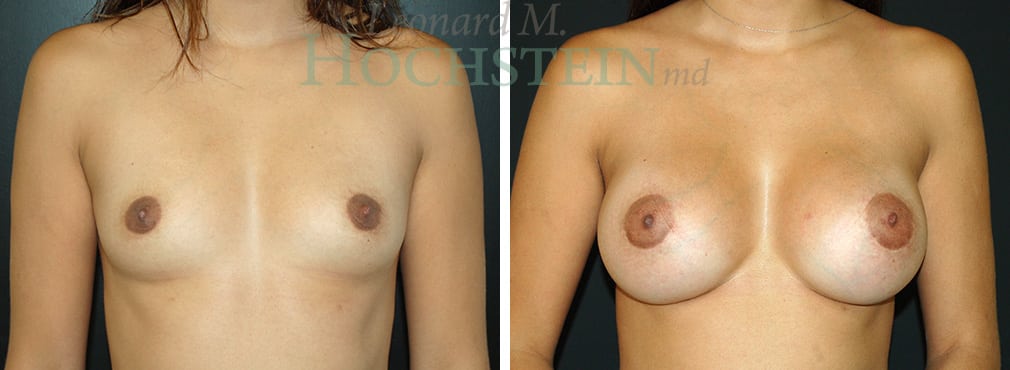 Breast Augmentation Patient